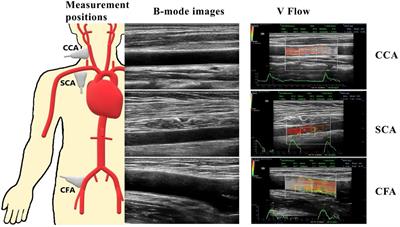 Investigation on the differences of hemodynamics in normal common carotid, subclavian, and common femoral arteries using the vector flow technique